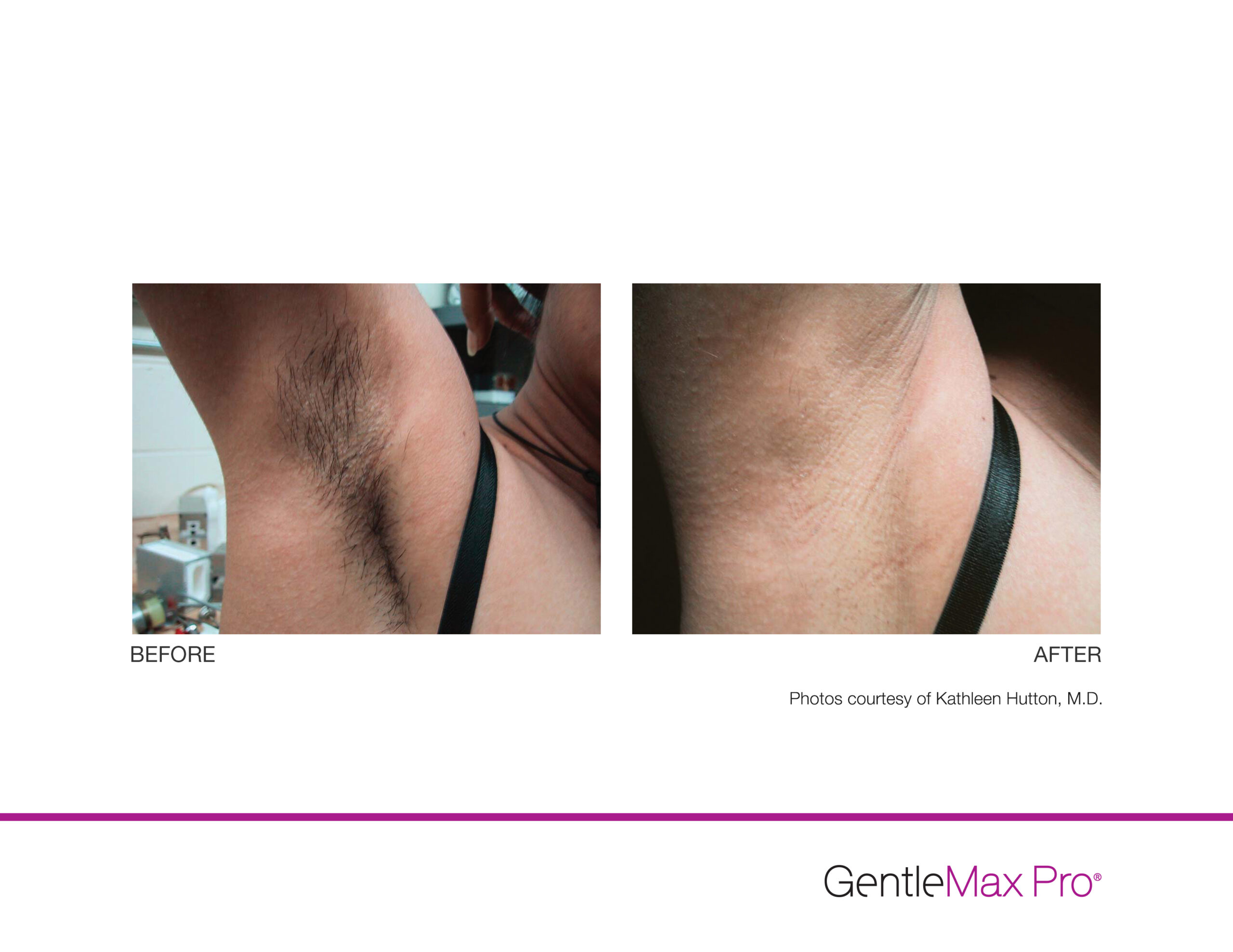 Gentlemax Pro Armpit Result, Laser hair removal montreal