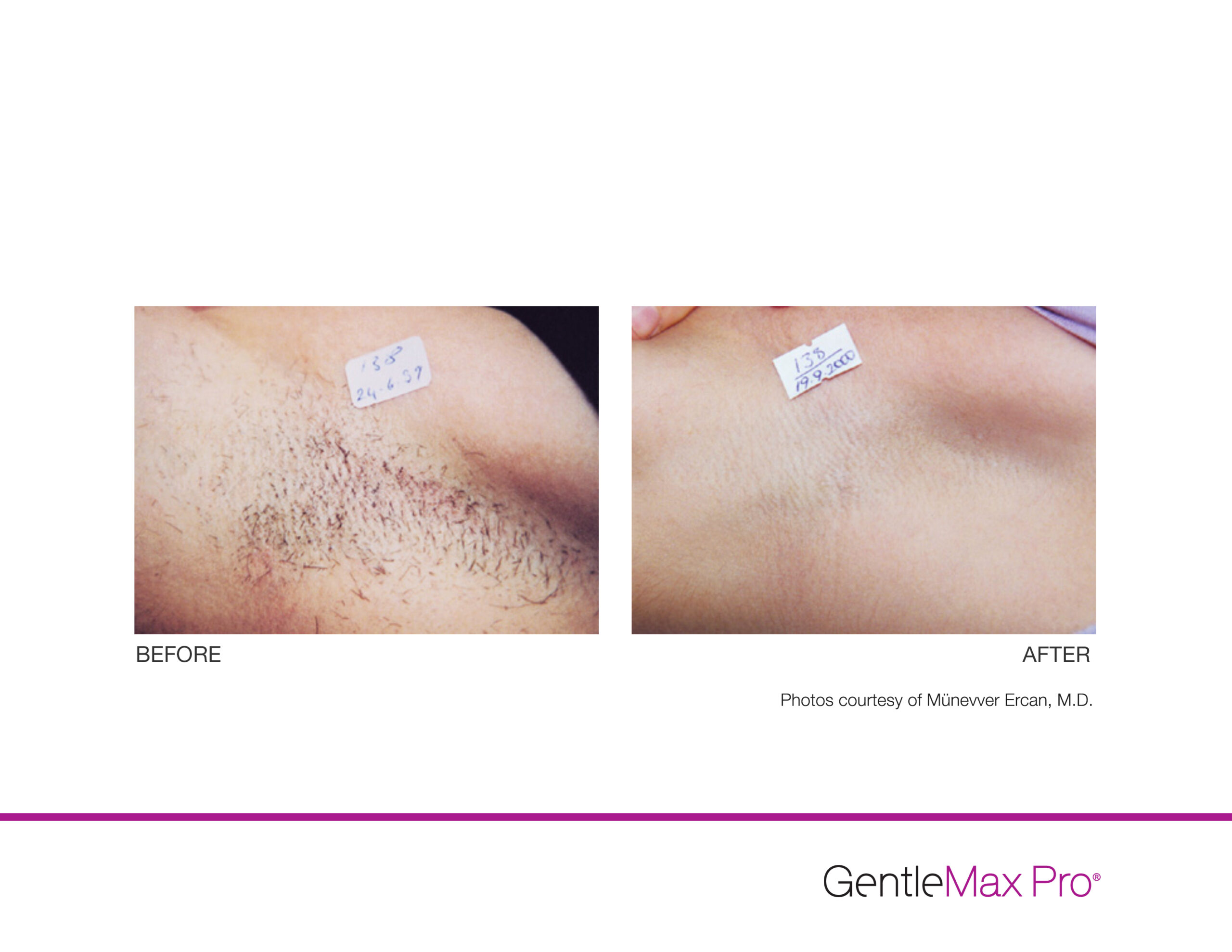 Gentle Max Pro Laser hair removal on armpit results, laser hair removal montreal